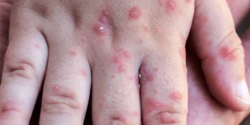 Alemania establece 21 días de cuarentena por viruela del mono