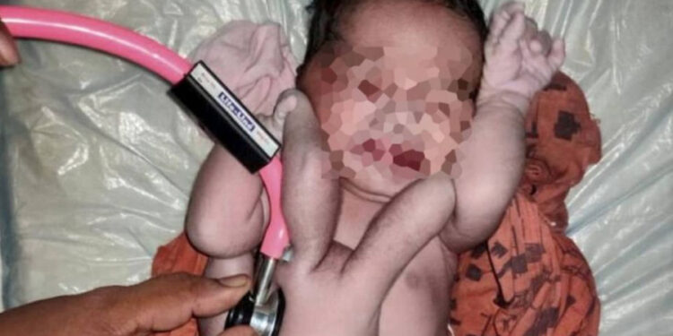 Nace bebé con cuatro brazos y cuarto piernas