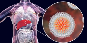 Alerta Salud de Tamaulipas por hepatitis C