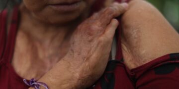 Penas de 15 años de cárcel a quienes agredan a mujeres con ácido en Tamaulipas