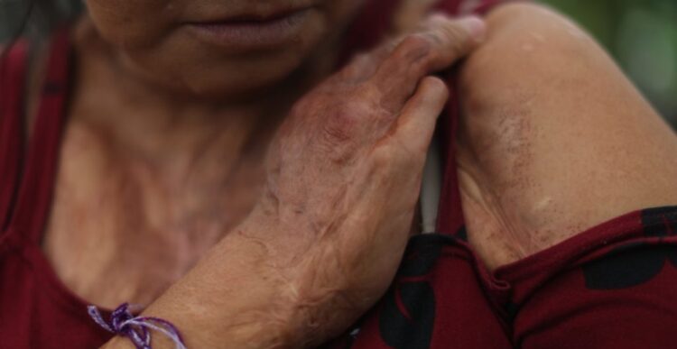 Penas de 15 años de cárcel a quienes agredan a mujeres con ácido en Tamaulipas