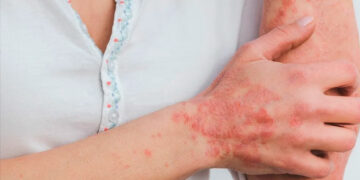 La Lepra se Convierte en Endémica en el Sureste de EE.UU.