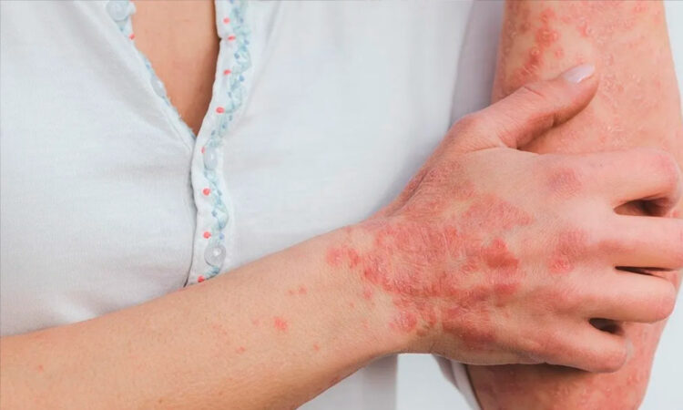 La Lepra se Convierte en Endémica en el Sureste de EE.UU.