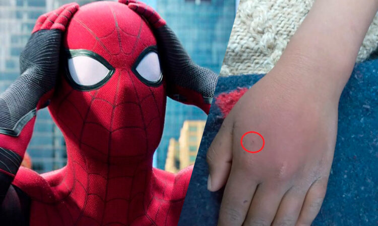 Niño en Bolivia es hospitalizado tras dejarse picar por araña intentando ser Spider-Man»