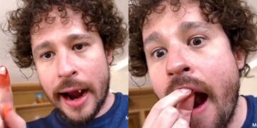 Luisito Comunica se le caen los dientes