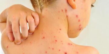 aumentan-casos-de-sarampión-en-México