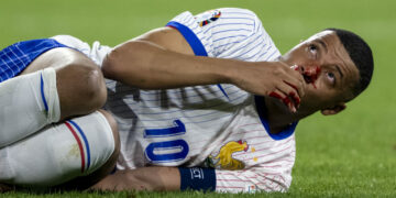 Kylian Mbappe fractura de nariz