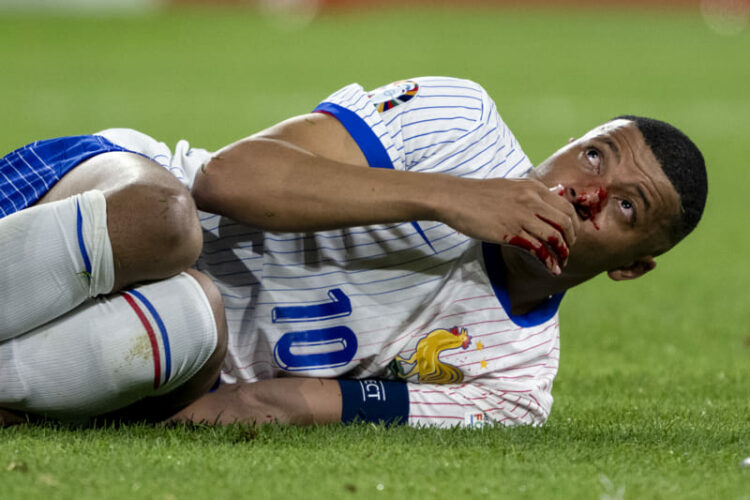 Kylian Mbappe fractura de nariz