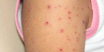 Padres omiten vacunar y varicela sube en Tamaulipas, alertan autoridades