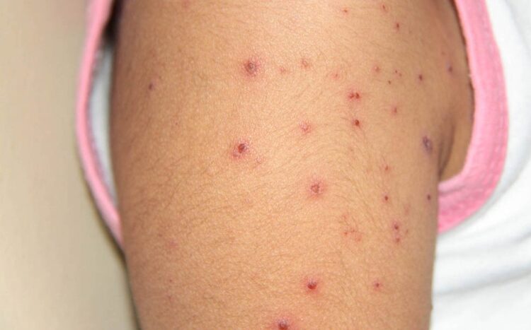 Padres omiten vacunar y varicela sube en Tamaulipas, alertan autoridades